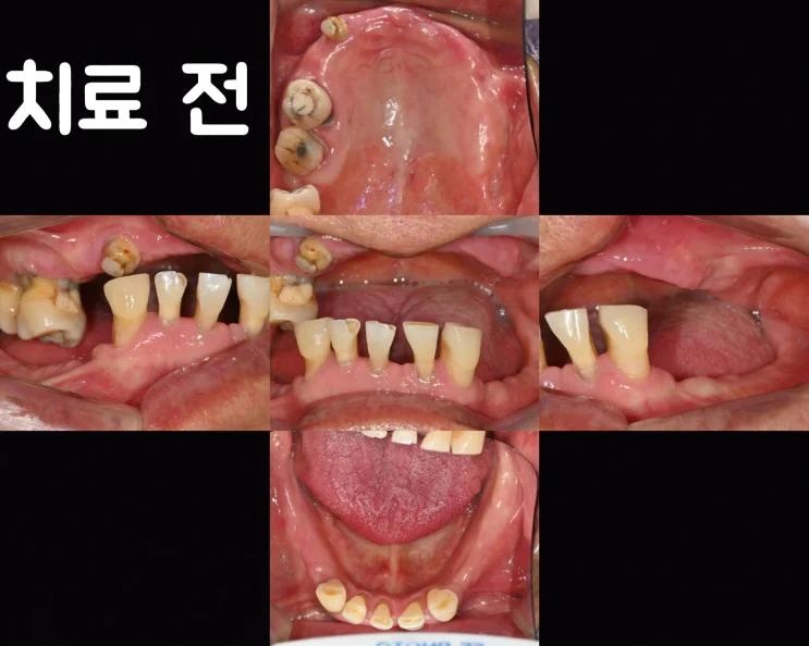 수면 임플란트