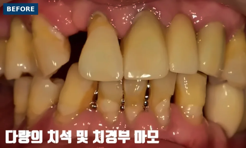 수면 임플란트