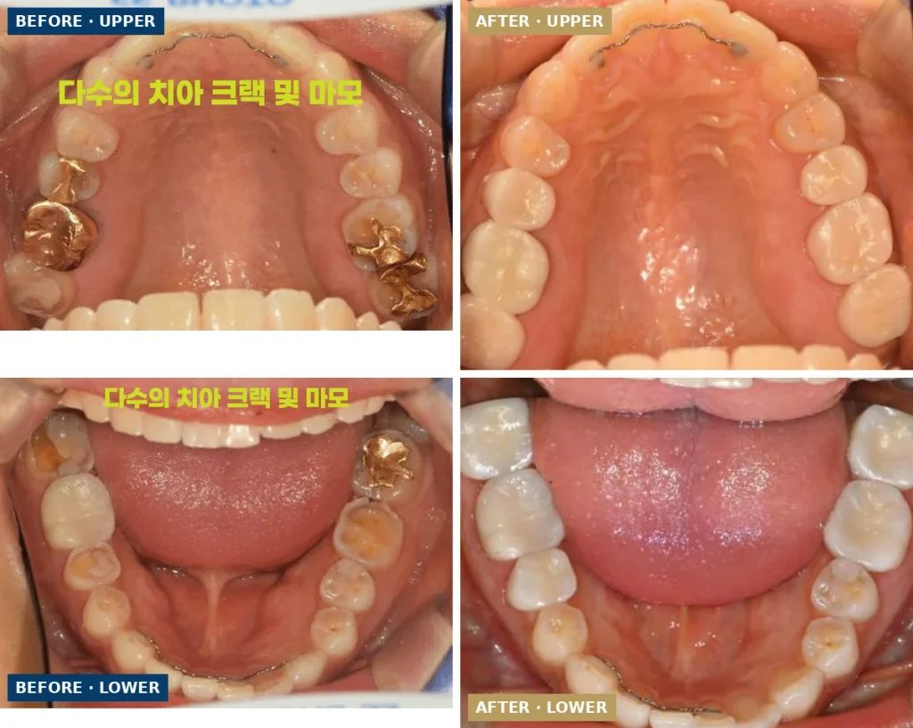 금 간 치아