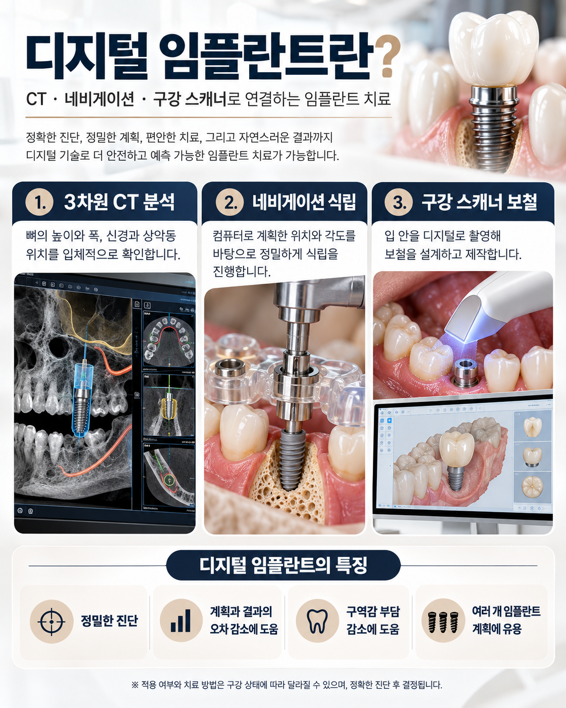 구강 스캐너로 완성한 디지털 임플란트, 여러 개 빠진 어금니를 회복한 과정 | 명일동 치과에서 설명드립니다
