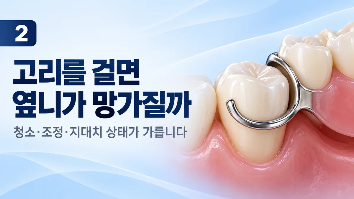부분틀니 고리와 옆니 부담, 청소·조정·지대치 상태가 가릅니다