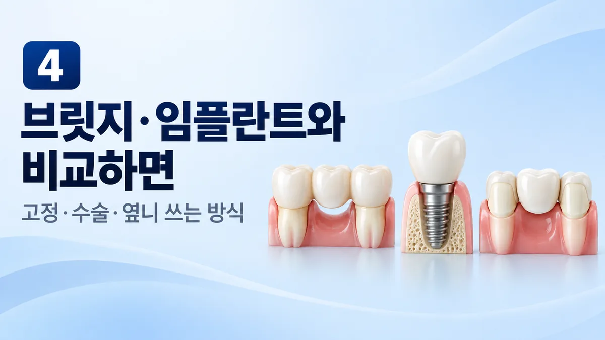 부분틀니와 브릿지, 임플란트 비교