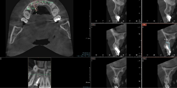Precise analysis of alveolar bone and nerve location via CT scan