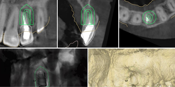 3D analysis to determine implant placement position, angulation, and depth