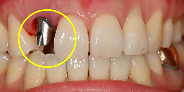 After extraction, precise placement using surgical guide followed by pre-fabricated abutment connection