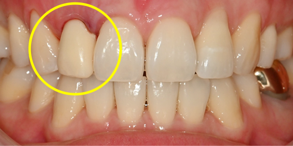 Prosthesis completed on the day of surgery