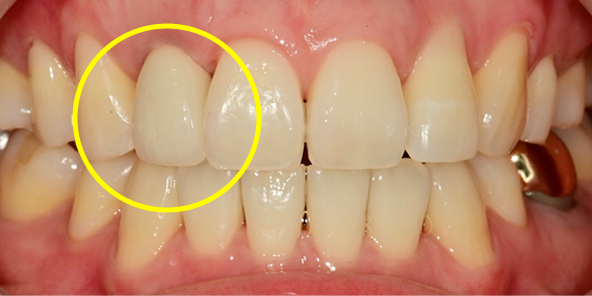 After 2 months, replaced with final prosthesis if gingival contour changes or as needed