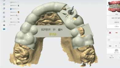 Surgical Guide Fabrication