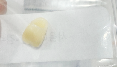 Immediate Temporary Prosthesis