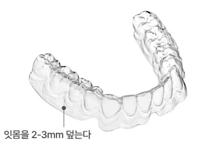 Standard Clear Aligner