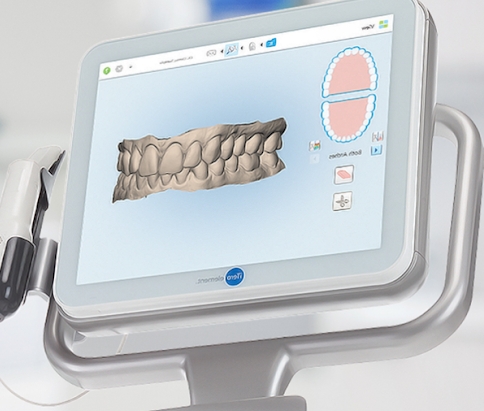 Advantages of 3D Scan Invisalign