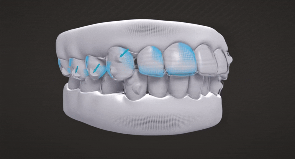 Treatment Roadmap Design for Invisalign HQ Fabrication