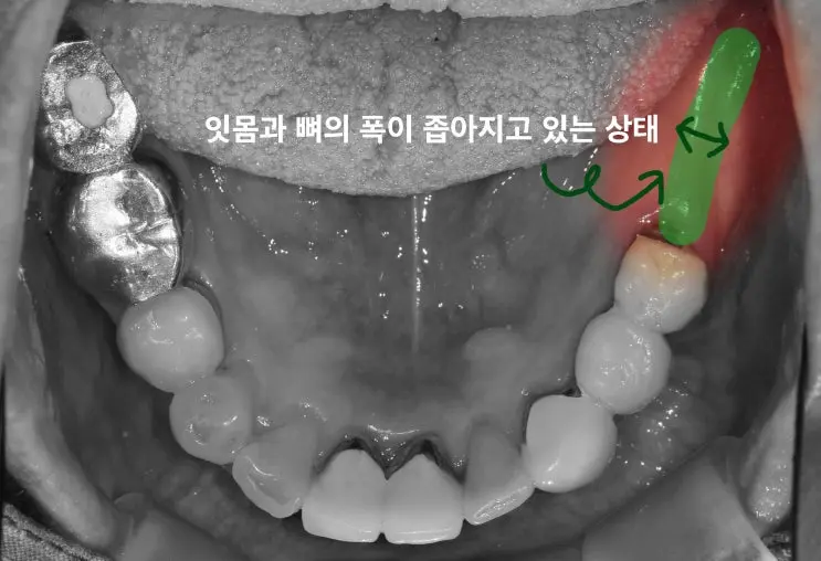 02 하악 구내사진 잇몸뼈폭 좁아짐
