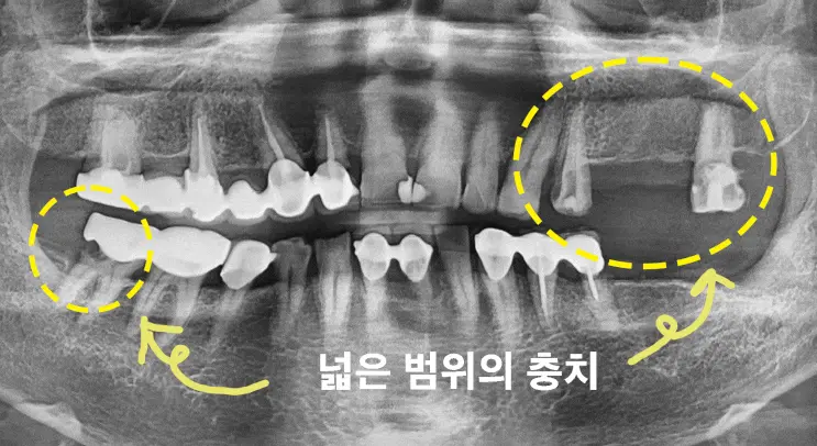 04 파노라마 넓은범위 충치