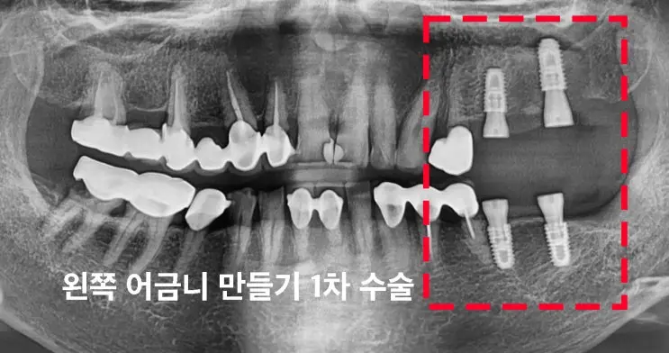07 왼쪽어금니 1차수술 파노라마