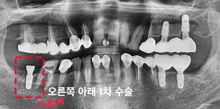 08 오른쪽아래 1차수술 파노라마