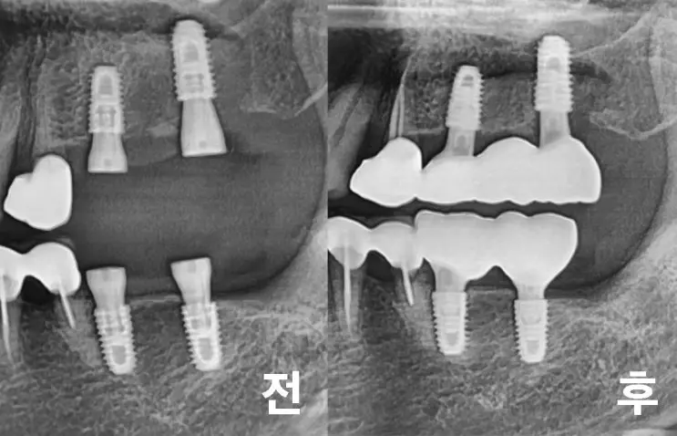 12 치료 전후 비교 엑스레이