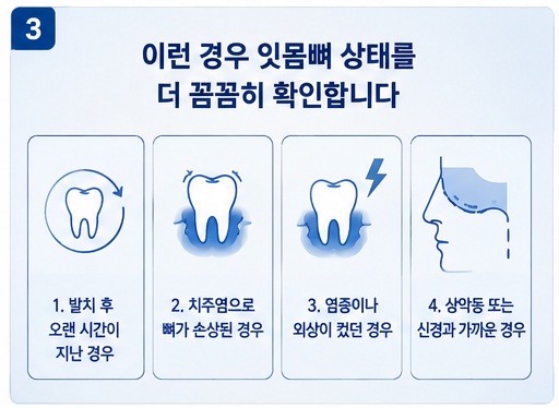 임플란트 뼈이식