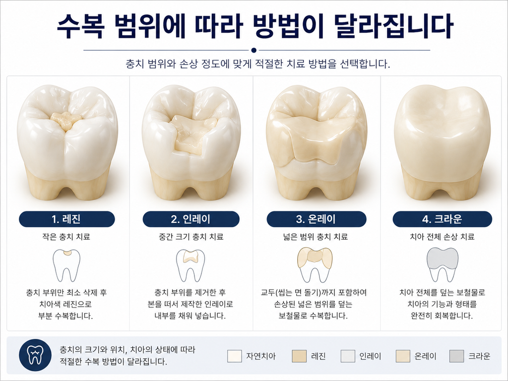 충치치료 종류