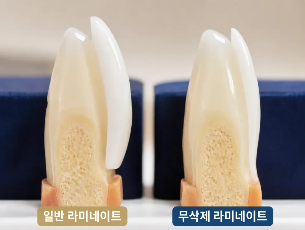 무삭제 라미네이트 비교