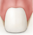 크라운 교체 후
