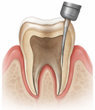 내부 변색 제거