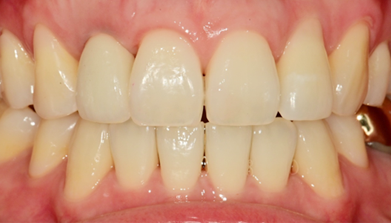 기능·심미 회복 완료