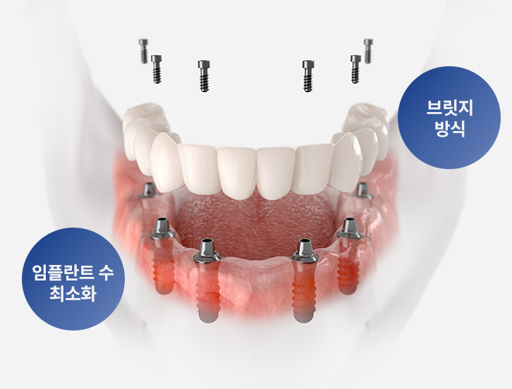 브릿지 방식 임플란트